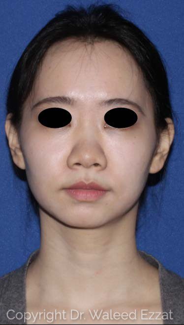 East Asian Rhinoplasty Patient Photo - Case 117 - before view-1