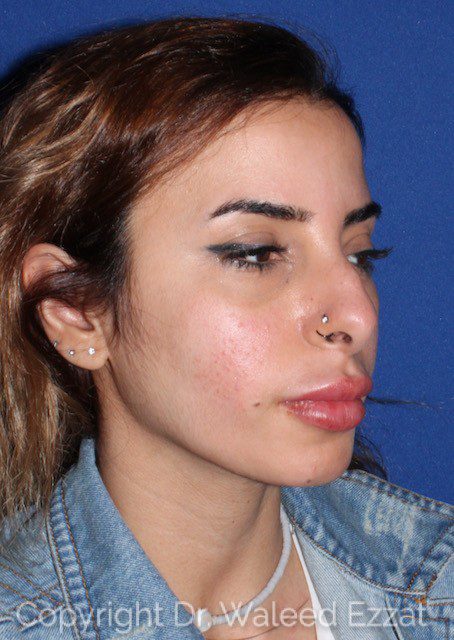 Mediterranean/Middle Eastern Rhinoplasty Patient Photo - Case 6617 - before view-1