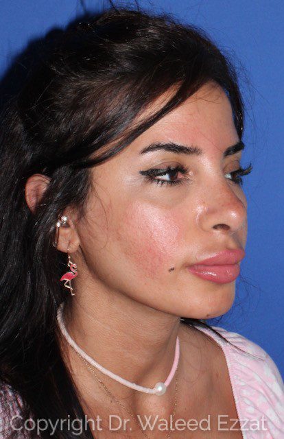 Mediterranean/Middle Eastern Rhinoplasty Patient Photo - Case 6617 - after view-1