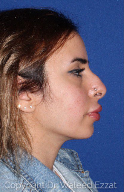 Mediterranean/Middle Eastern Rhinoplasty Patient Photo - Case 6617 - before view-