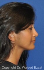 Rhinoplasty - Case 231 - After