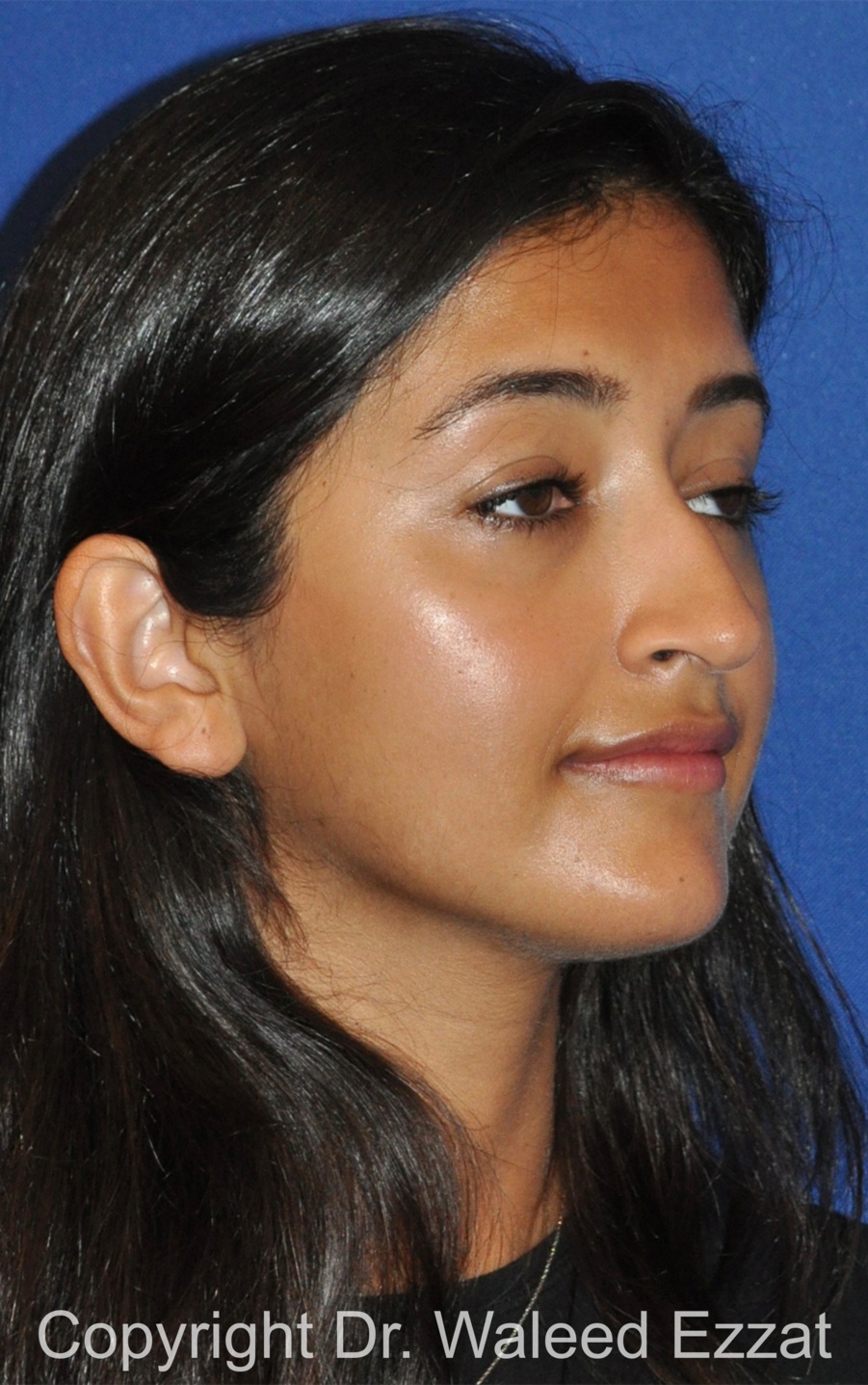 Southeast Asian Rhinoplasty Patient Photo - Case 231 - before view-1