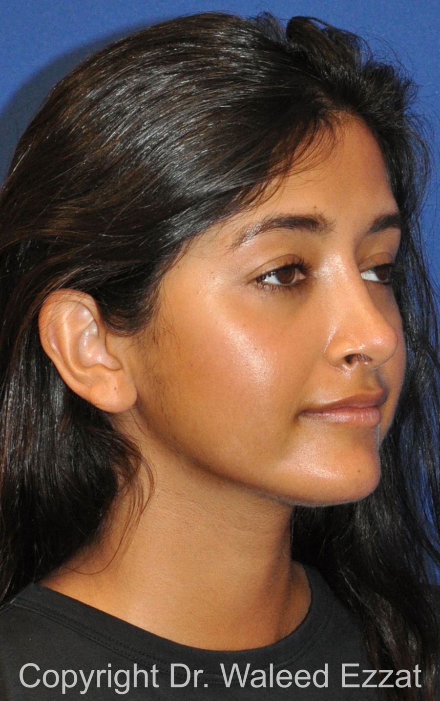 Southeast Asian Rhinoplasty Patient Photo - Case 231 - after view-1