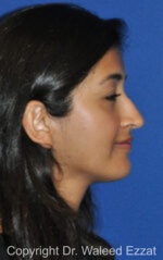 Rhinoplasty - Case 231 - Before