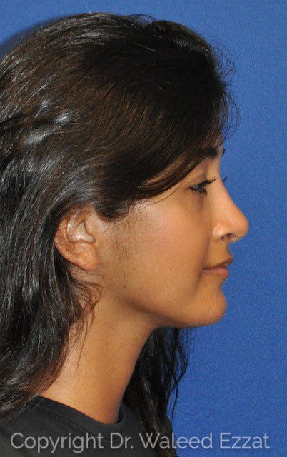 Rhinoplasty Patient Photo - Case 6619 - after view