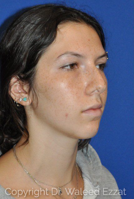 Hispanic/South American Rhinoplasty Patient Photo - Case 6639 - before view-1