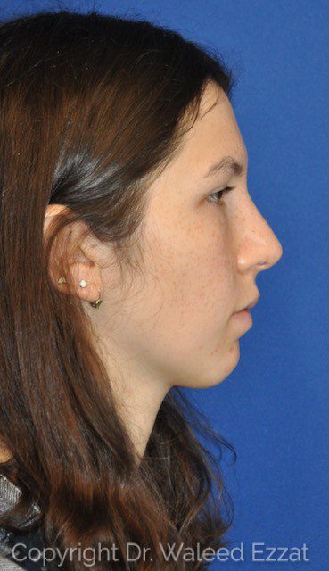 Hispanic/South American Rhinoplasty Patient Photo - Case 6639 - after view-0