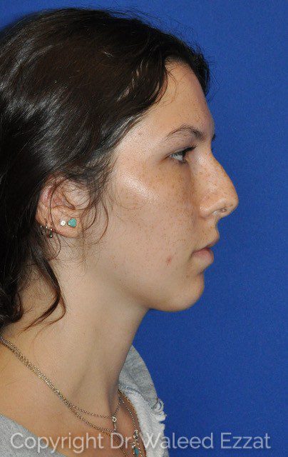 Hispanic/South American Rhinoplasty Patient Photo - Case 6639 - before view-0