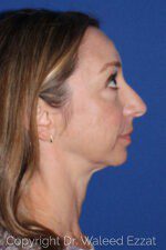Chin Augmentation - Case 6653 - Before