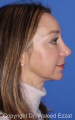 Chin Augmentation - Case 34 - After