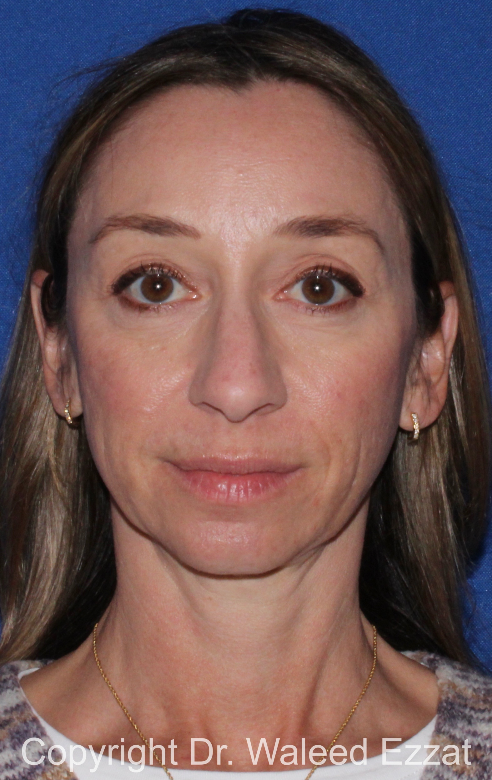 Chin Augmentation Patient Photo - Case 34 - before view-2