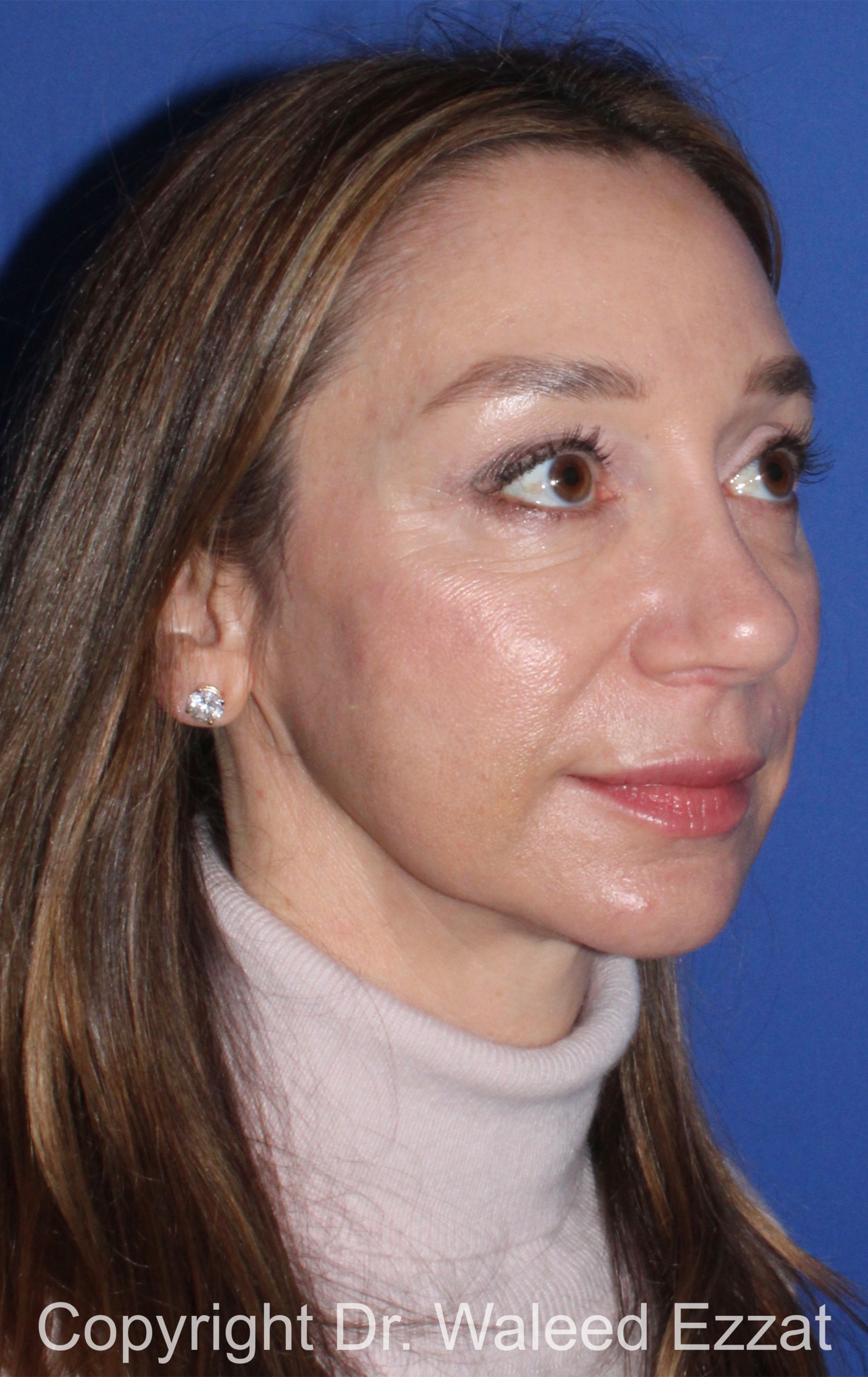 Chin Augmentation Patient Photo - Case 34 - after view-1