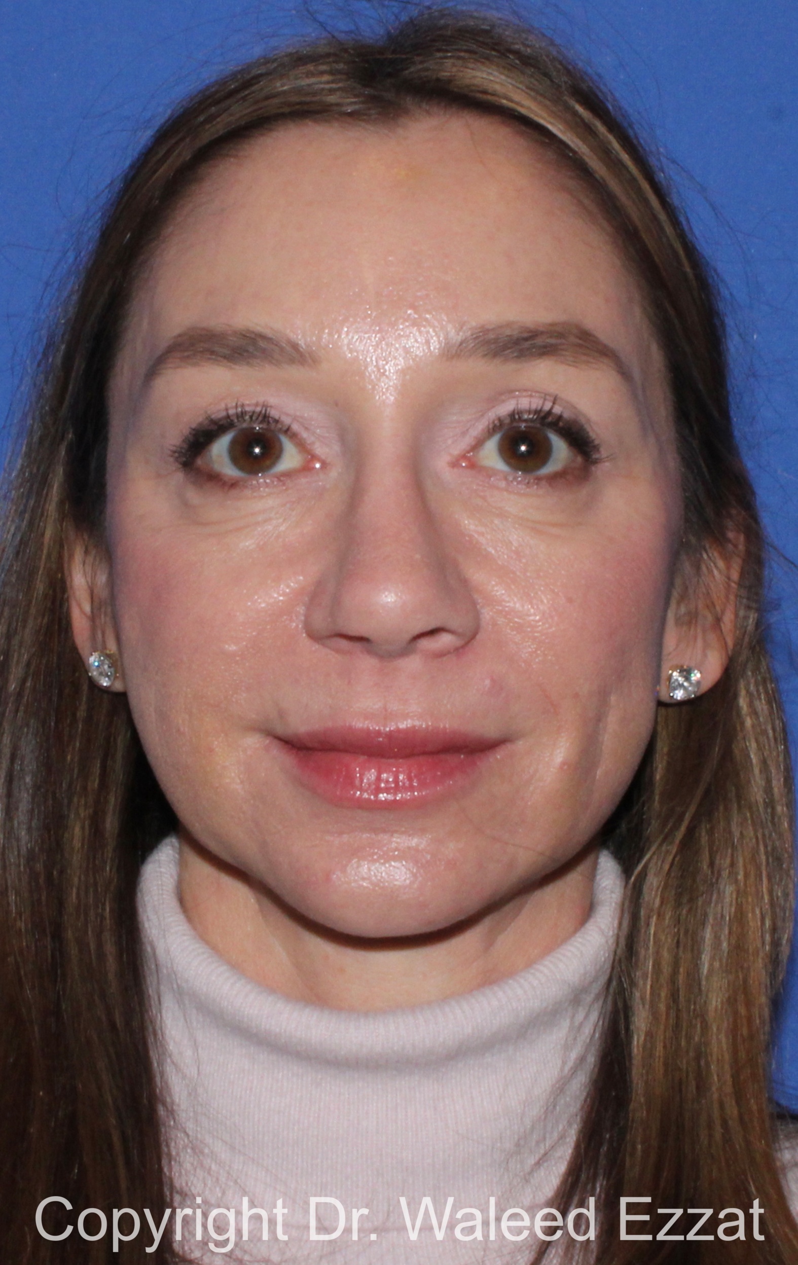 Chin Augmentation Patient Photo - Case 34 - after view-2