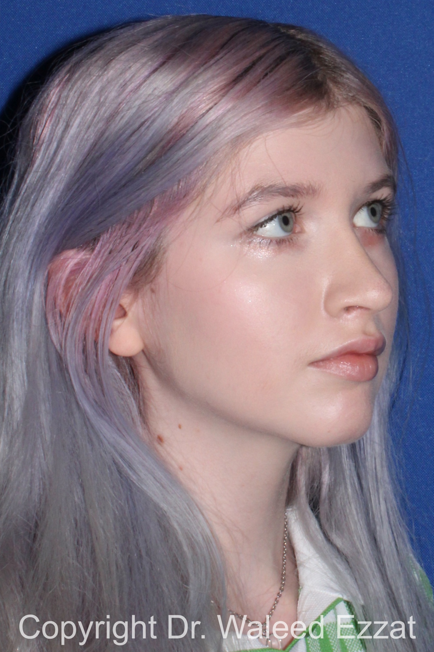 Caucasian/European Rhinoplasty Patient Photo - Case 81 - after view-1