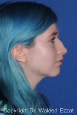 Caucasian/European Rhinoplasty - Case 81 - Before