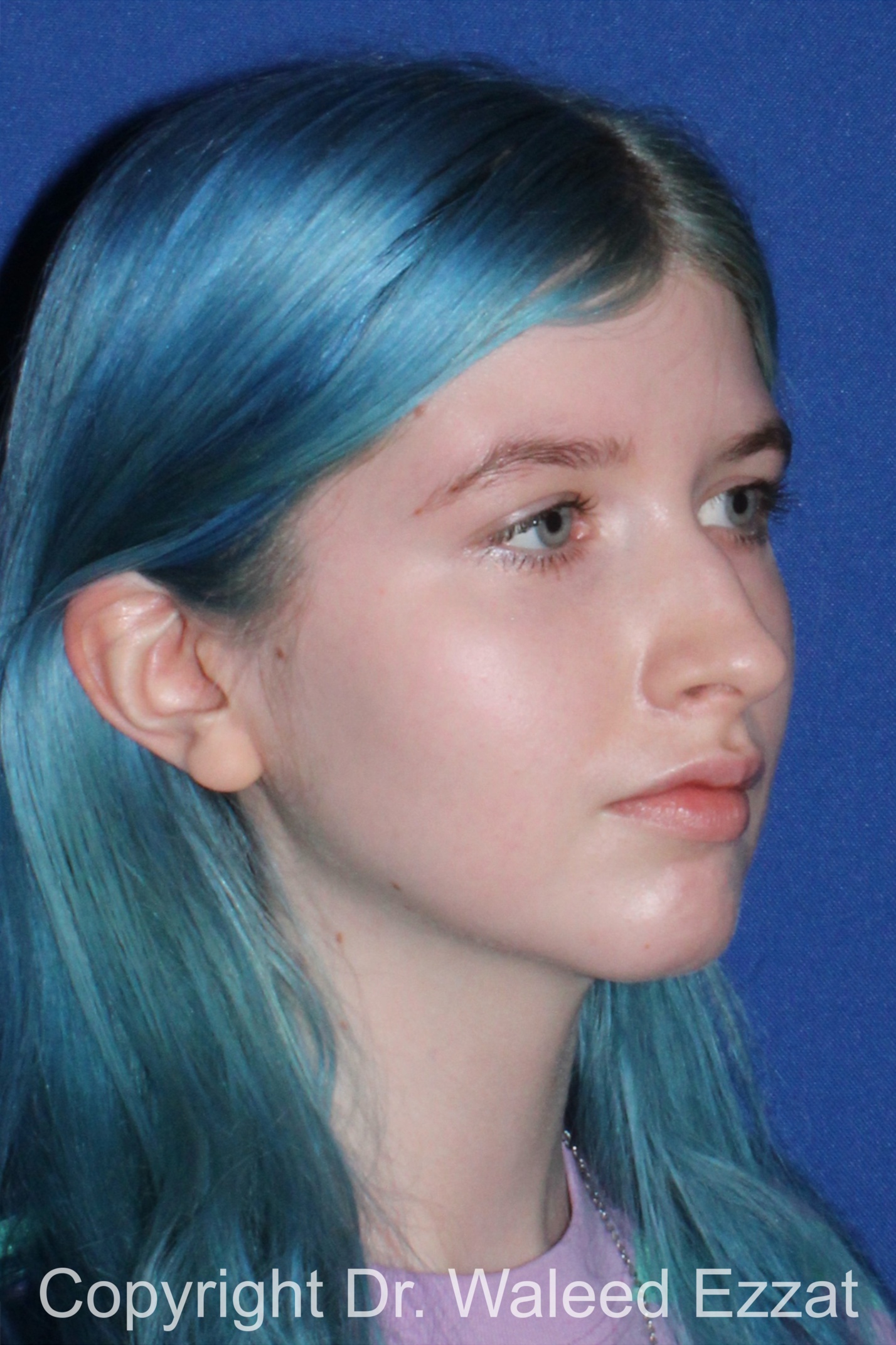 Caucasian/European Rhinoplasty Patient Photo - Case 81 - before view-1