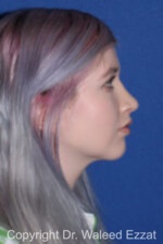 Caucasian/European Rhinoplasty - Case 81 - After