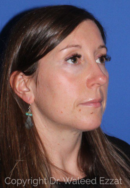 Rhinoplasty Patient Photo - Case 40 - after view-1