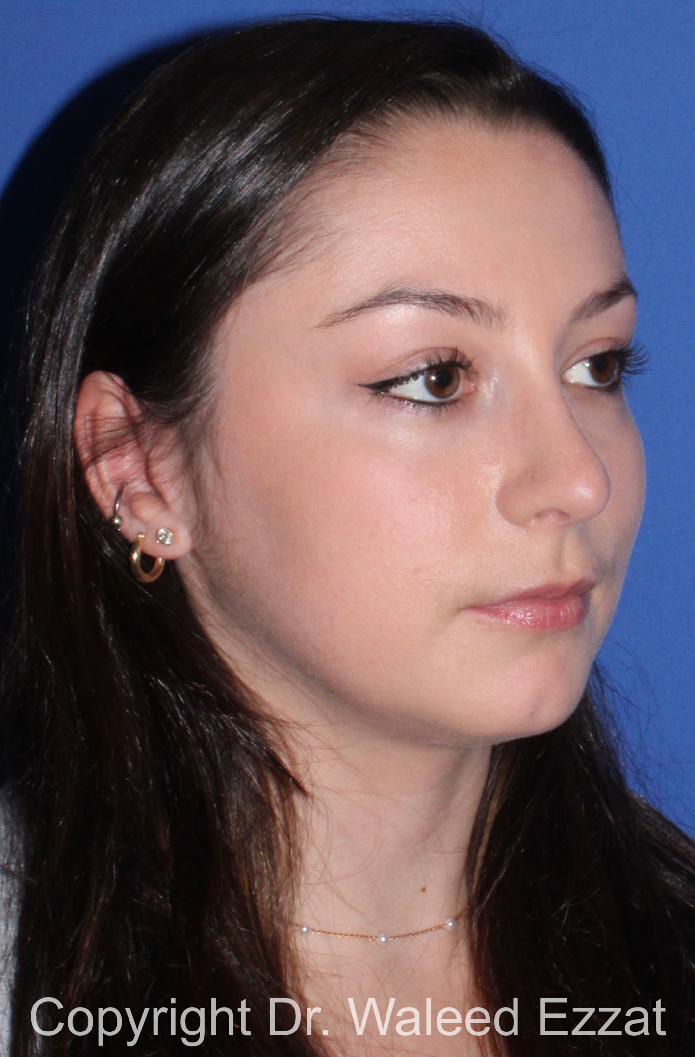 Rhinoplasty Patient Photo - Case 90 - after view-1