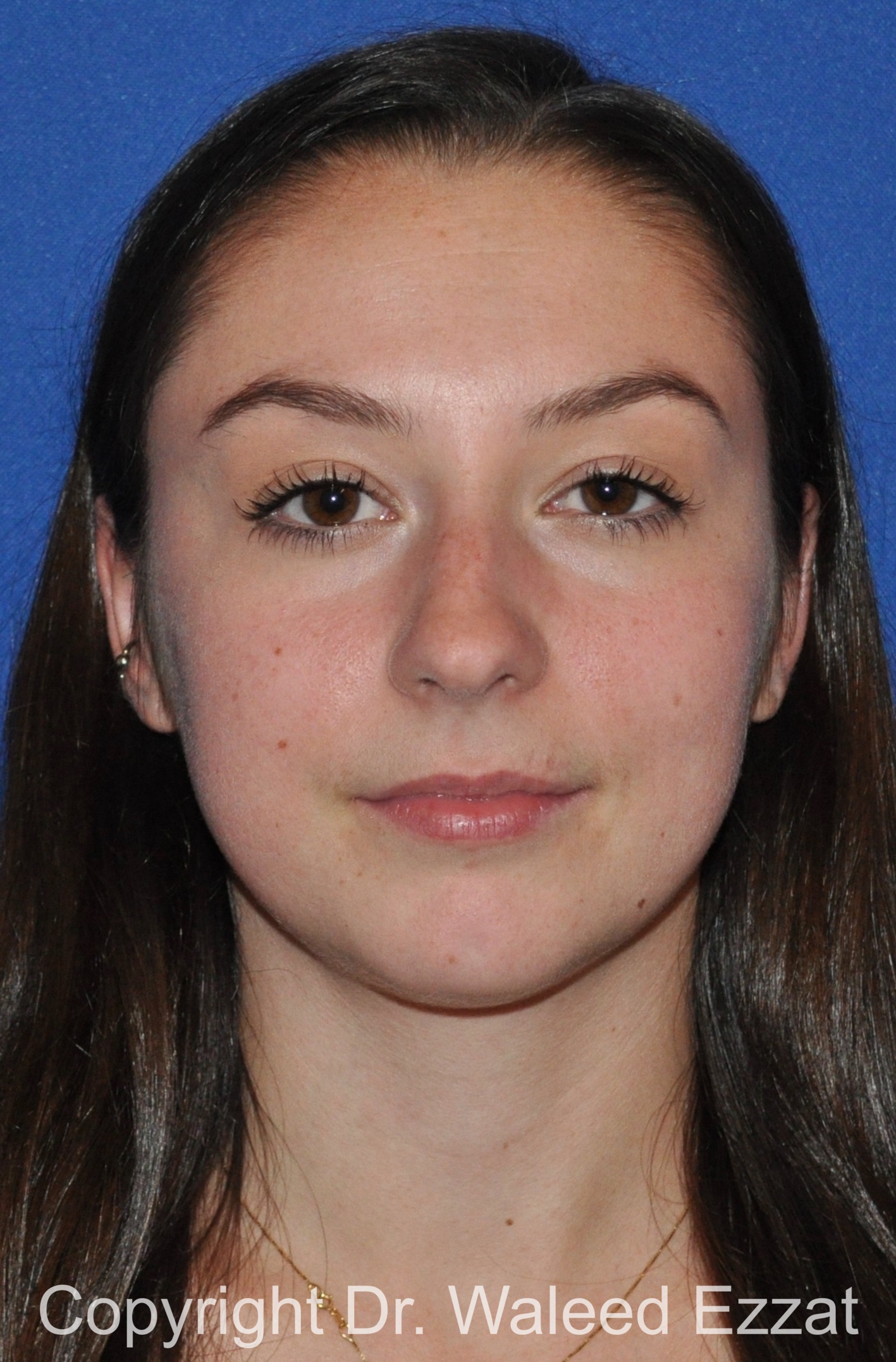 Rhinoplasty Patient Photo - Case 90 - before view-2