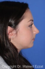 Caucasian/European Rhinoplasty - Case 90 - After