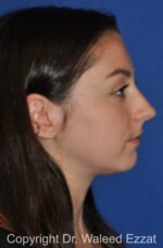 Caucasian/European Rhinoplasty - Case 90 - Before