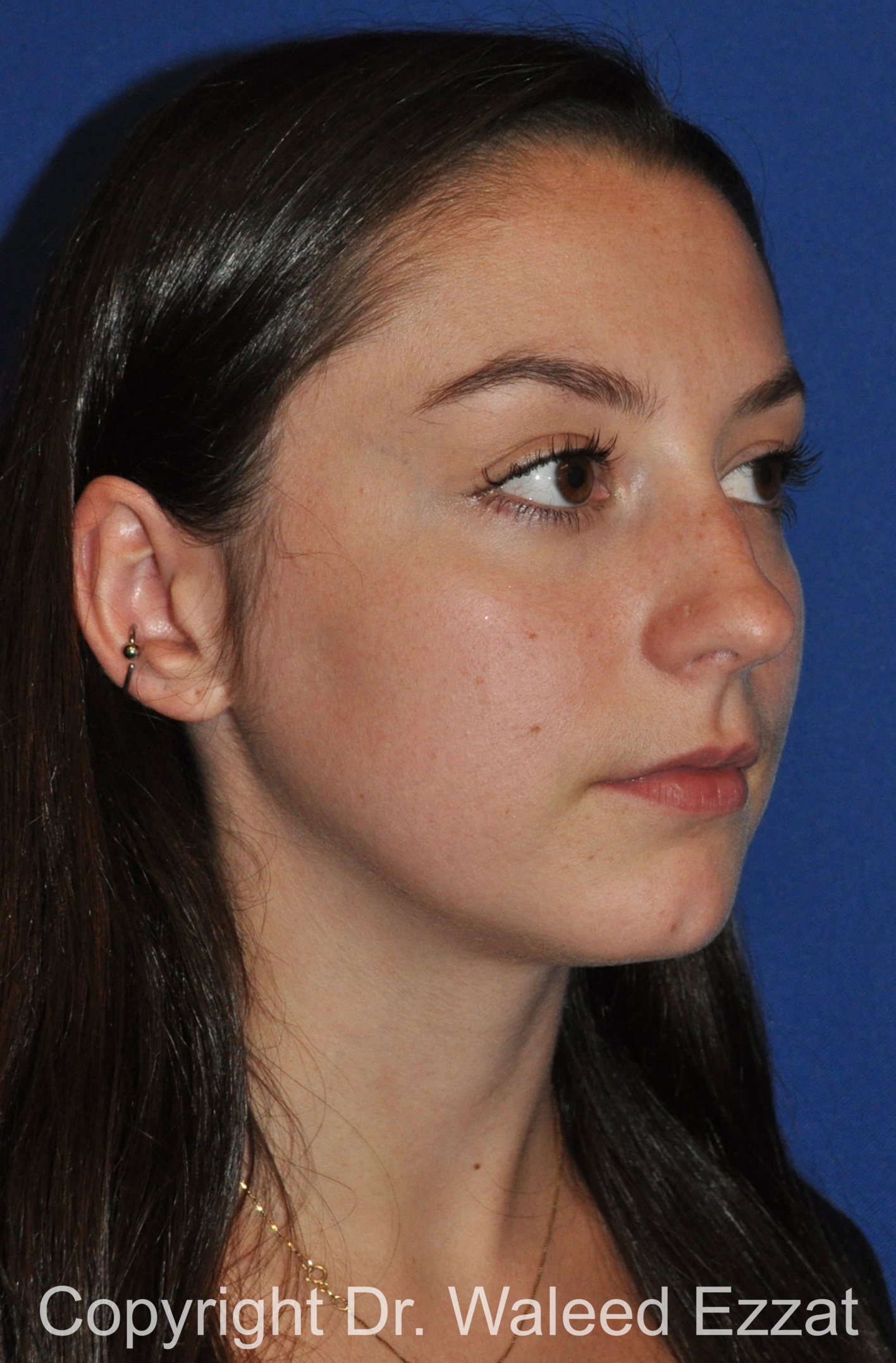 Rhinoplasty Patient Photo - Case 90 - before view-1