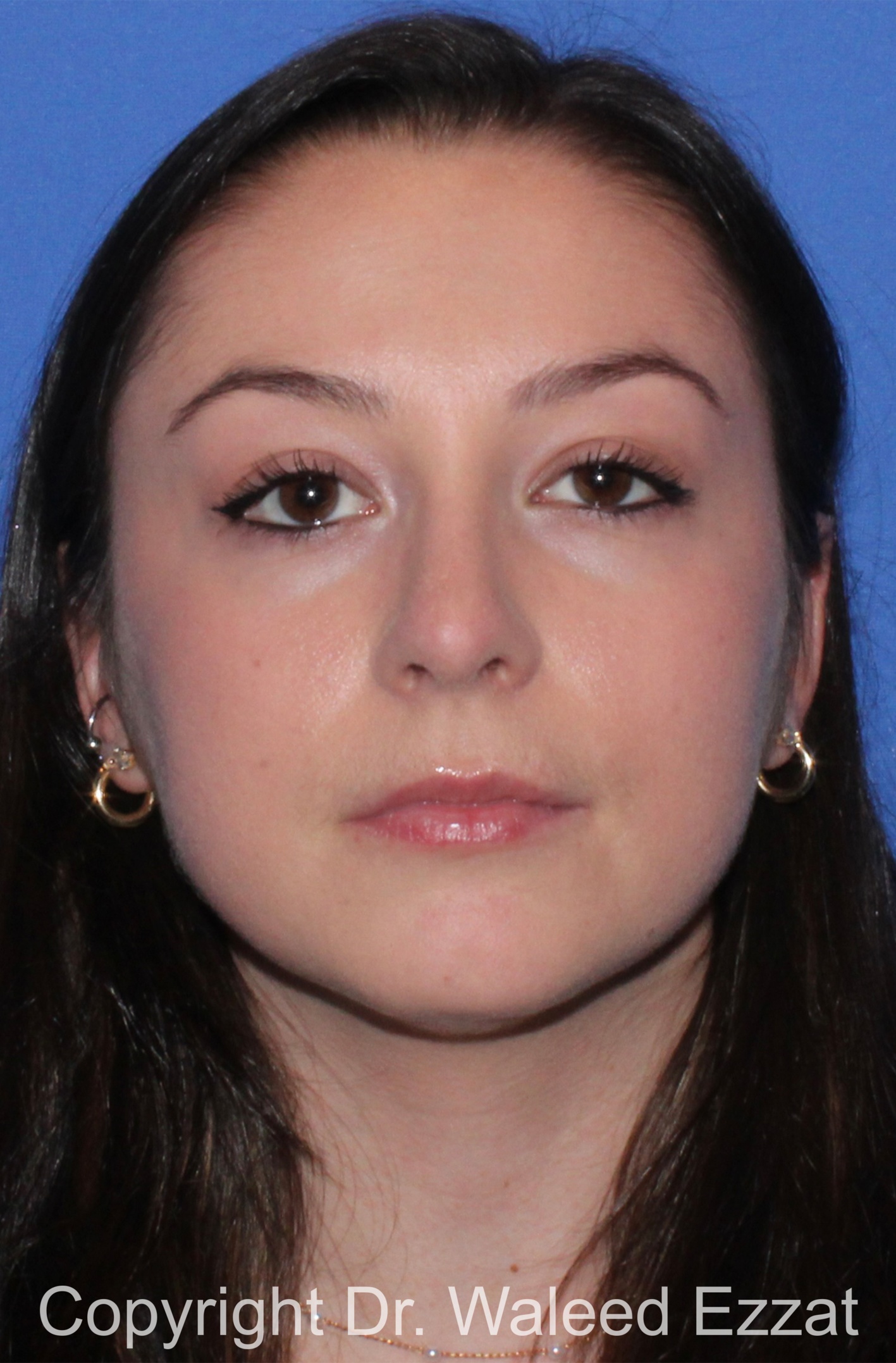 Rhinoplasty Patient Photo - Case 90 - after view-2