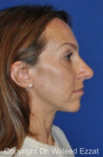 Caucasian/European Rhinoplasty - Case 99 - Before