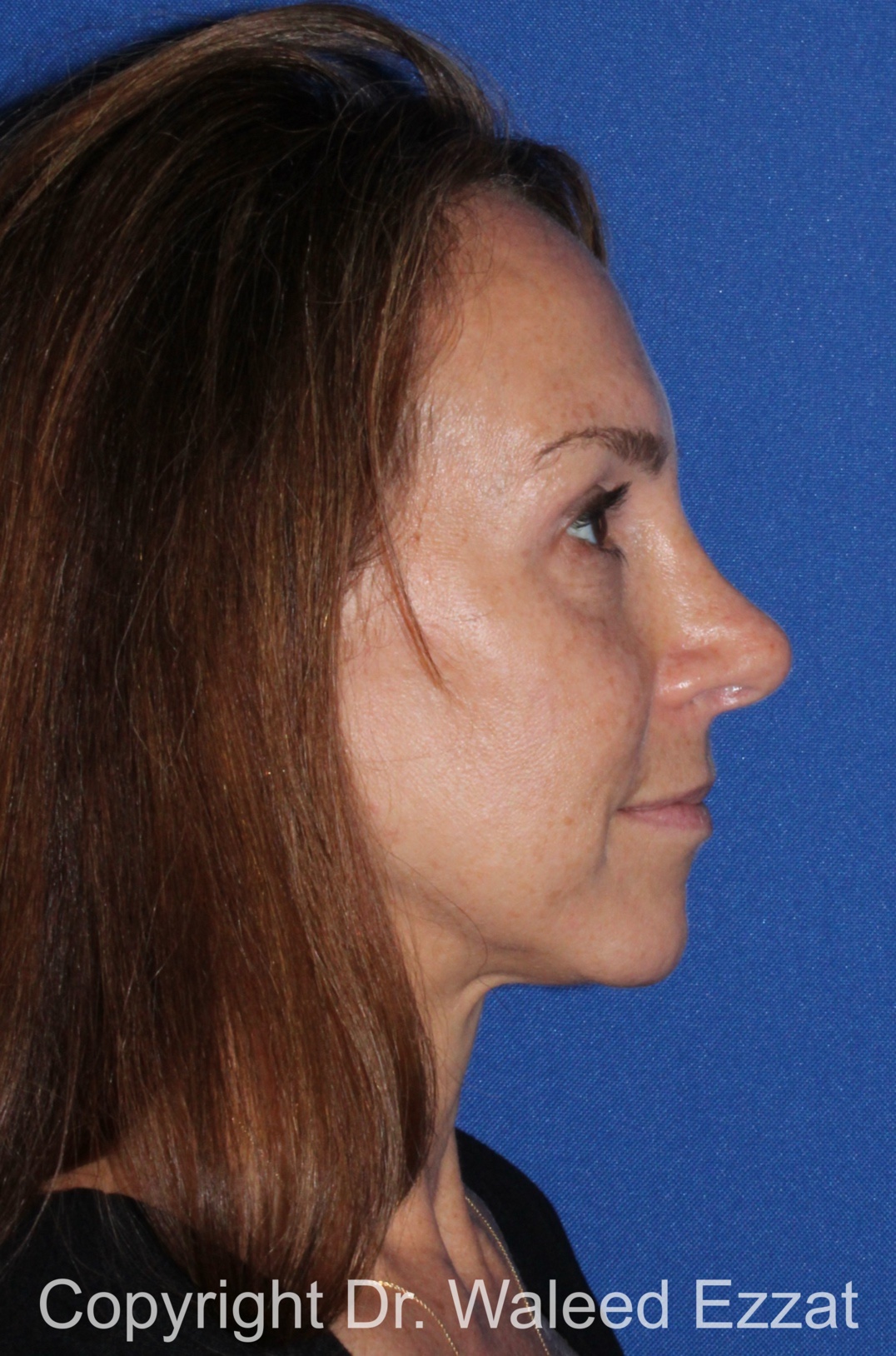 Rhinoplasty Patient Photo - Case 99 - after view