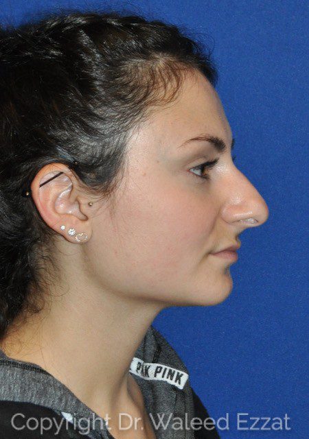 Mediterranean/Middle Eastern Rhinoplasty Patient Photo - Case 6715 - before view-0