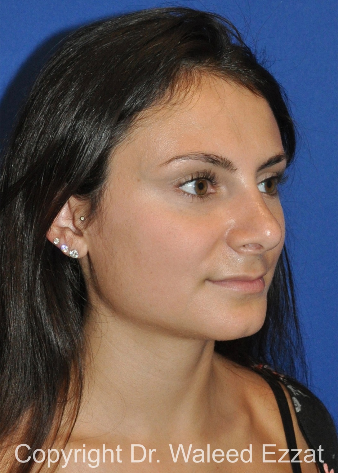 Mediterranean/Middle Eastern Rhinoplasty Patient Photo - Case 657 - after view-1