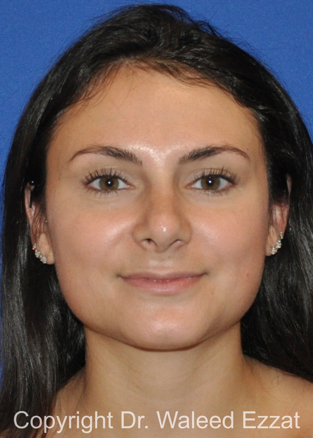 Mediterranean/Middle Eastern Rhinoplasty Patient Photo - Case 657 - after view-2