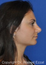 Mediterranean/Middle Eastern Rhinoplasty - Case 657 - After