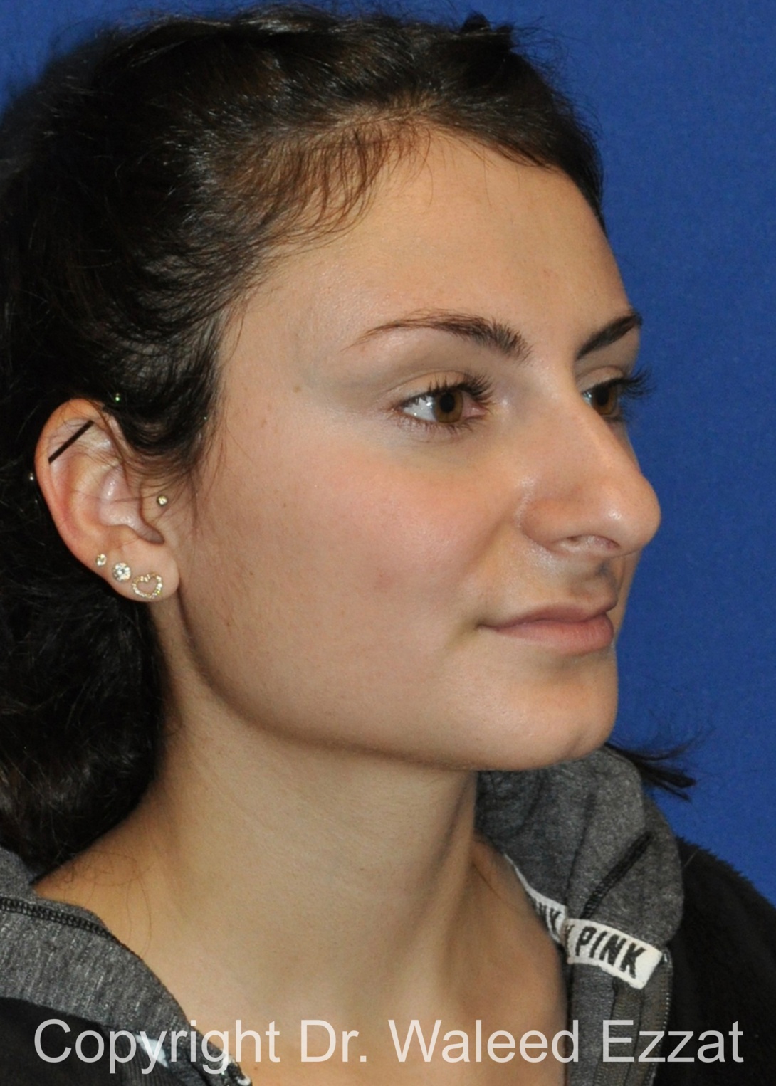 Mediterranean/Middle Eastern Rhinoplasty Patient Photo - Case 657 - before view-1