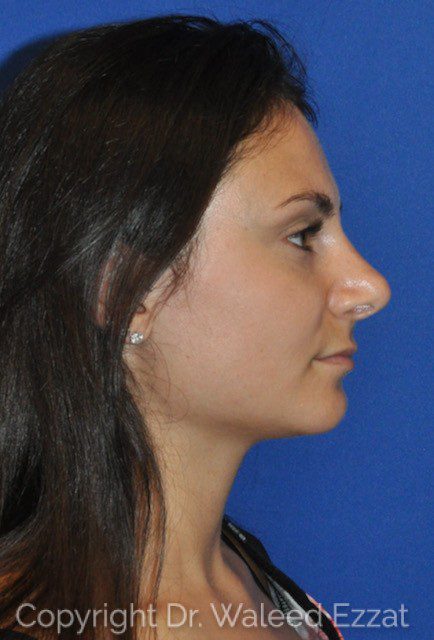 Mediterranean/Middle Eastern Rhinoplasty Patient Photo - Case 6715 - after view