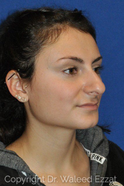 Mediterranean/Middle Eastern Rhinoplasty Patient Photo - Case 6715 - before view-1