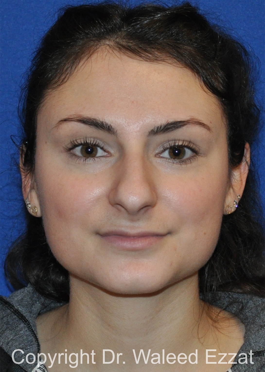 Mediterranean/Middle Eastern Rhinoplasty Patient Photo - Case 657 - before view-2