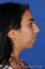 Chin Augmentation - Case 6867 - After