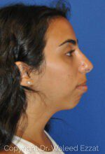 Chin Augmentation - Case 6867 - Before