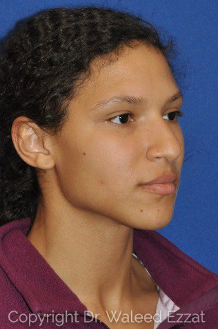 African/Caribbean Rhinoplasty Patient Photo - Case 7607 - before view-1