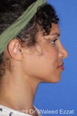 African/Caribbean Rhinoplasty - Case 202 - After