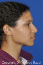 African/Caribbean Rhinoplasty - Case 202 - Before
