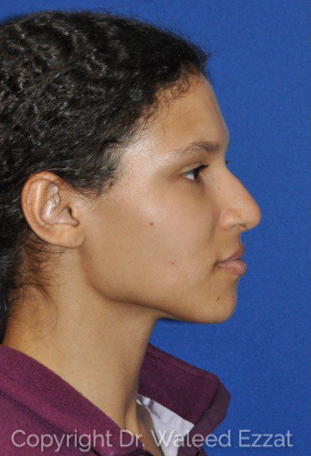 African/Caribbean Rhinoplasty Patient Photo - Case 7607 - before view-0