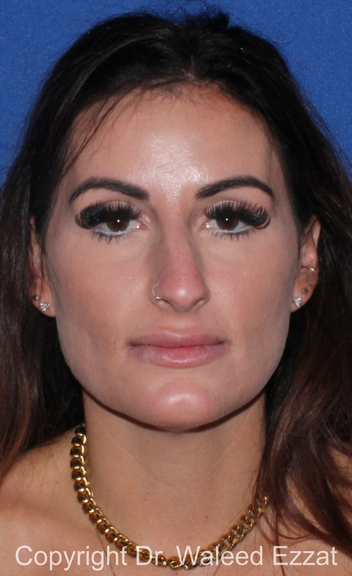 Mediterranean/Middle Eastern Rhinoplasty Patient Photo - Case 652 - before view-2