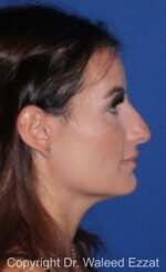 Mediterranean/Middle Eastern Rhinoplasty - Case 652 - Before