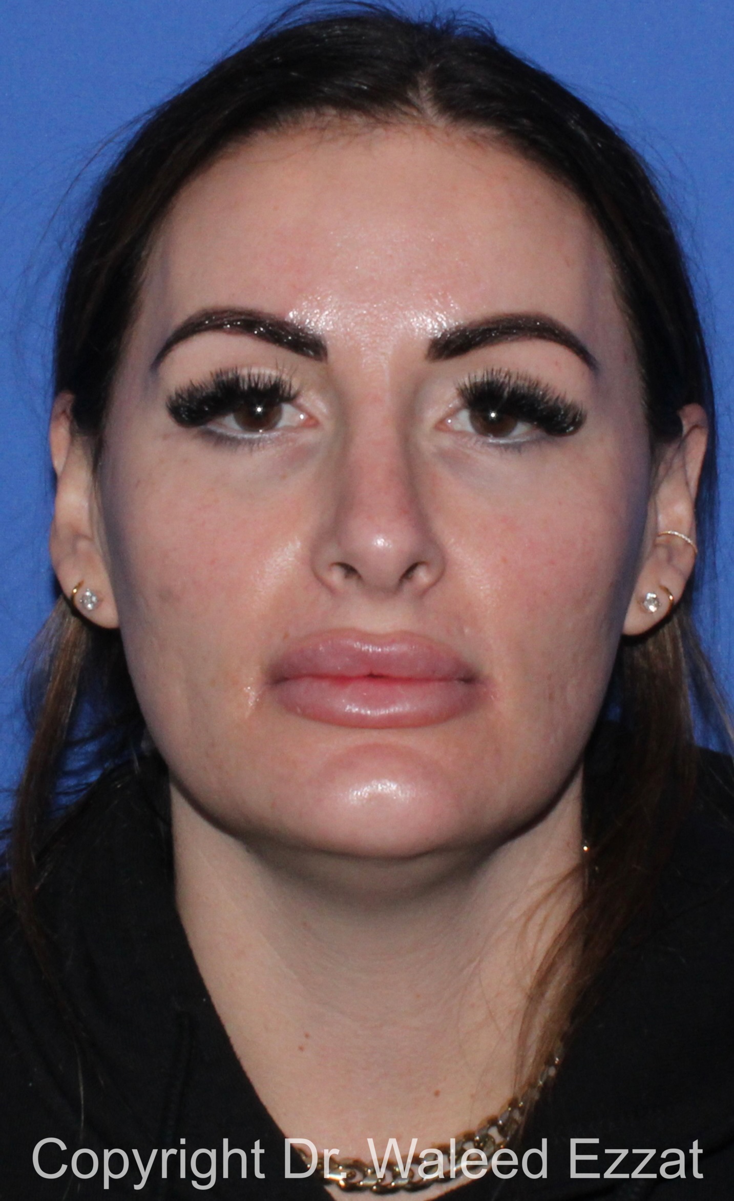 Mediterranean/Middle Eastern Rhinoplasty Patient Photo - Case 652 - after view-2