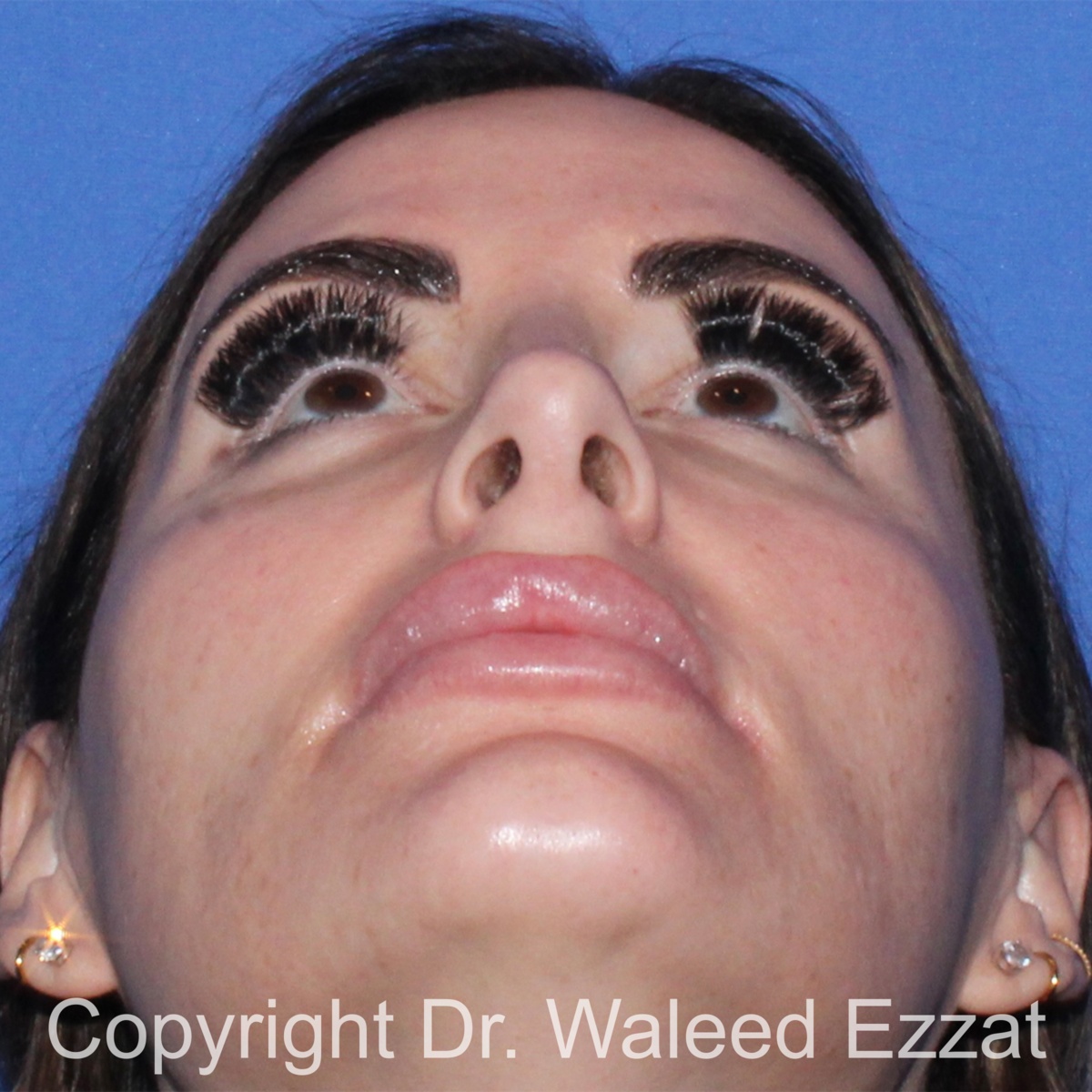 Mediterranean/Middle Eastern Rhinoplasty Patient Photo - Case 652 - after view-3