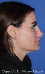 Mediterranean/Middle Eastern Rhinoplasty - Case 652 - After