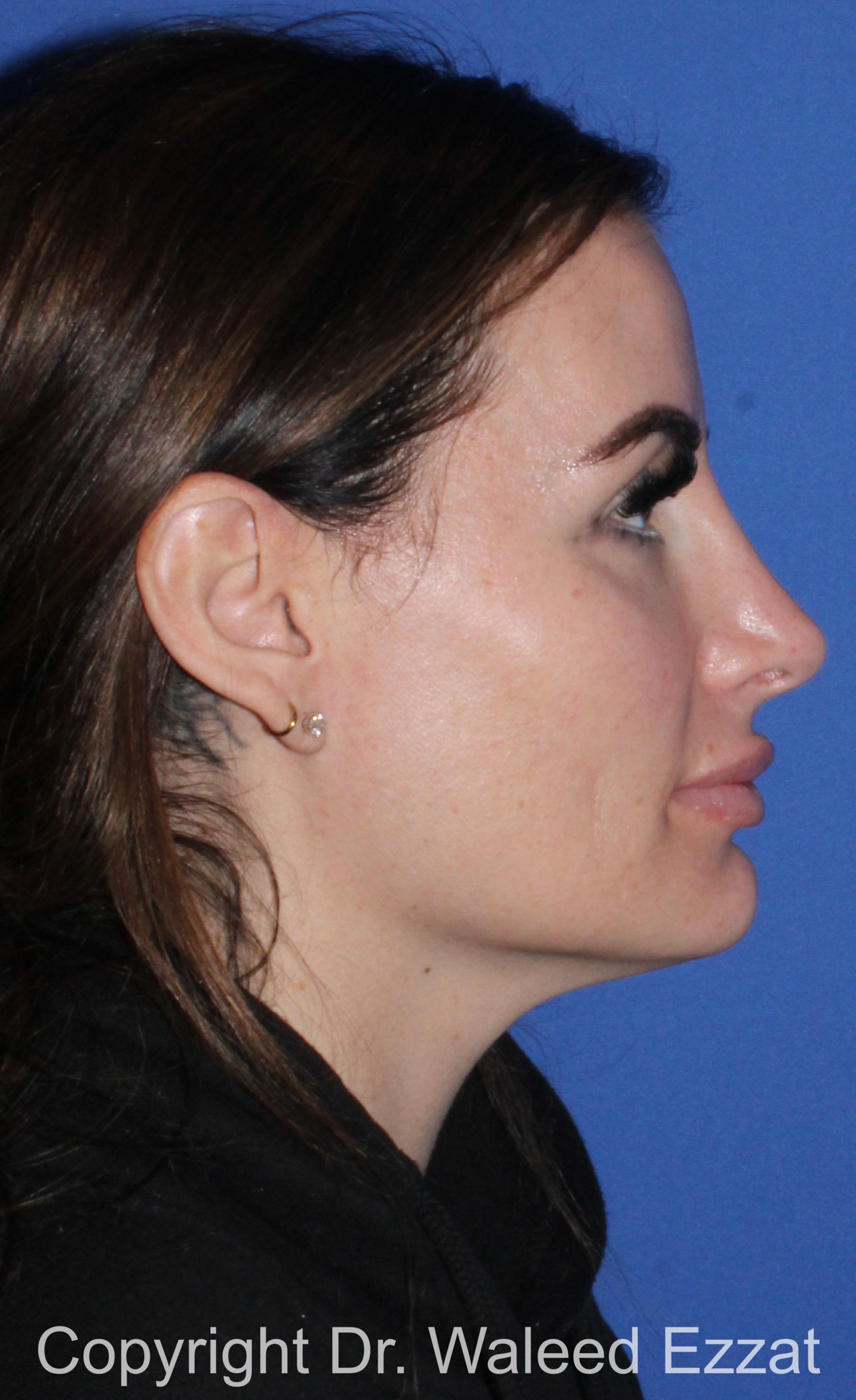 Mediterranean/Middle Eastern Rhinoplasty Patient Photo - Case 652 - after view